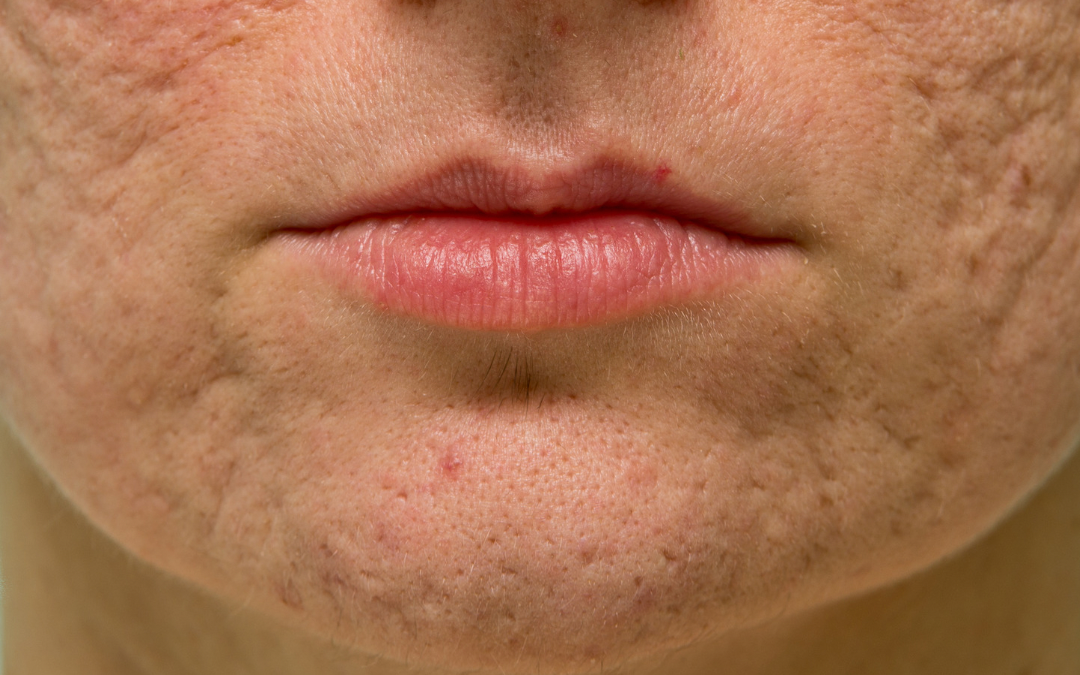 Qual o melhor tratamento para cicatrizes de acne?